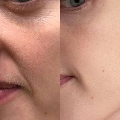 IPL Before & After Gallery - Patient 222793 - Image 1