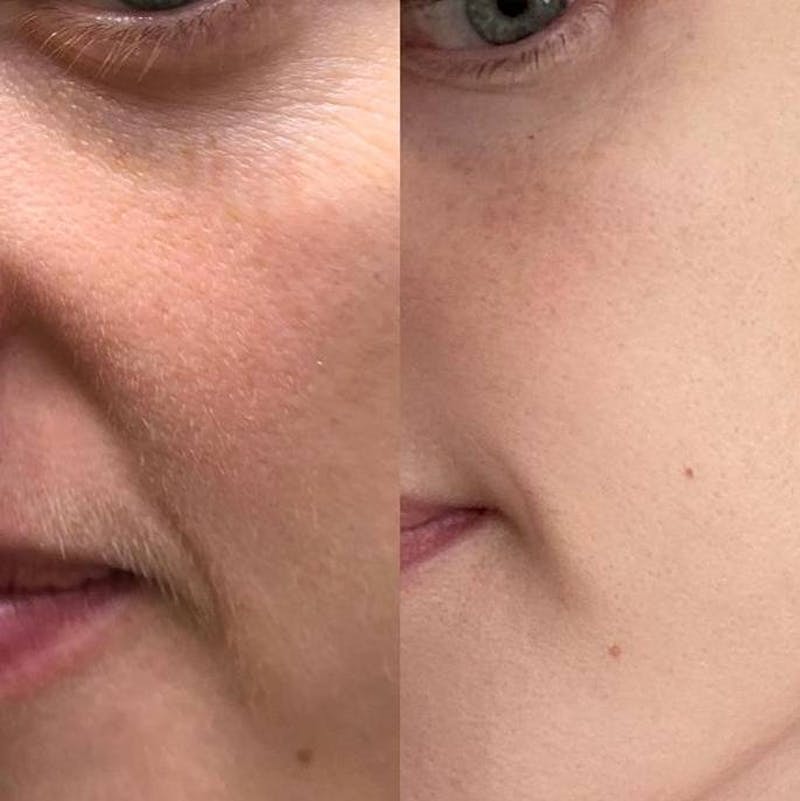 IPL Before & After Gallery - Patient 222793 - Image 1