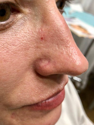 IPL Before & After Gallery - Patient 269829 - Image 1