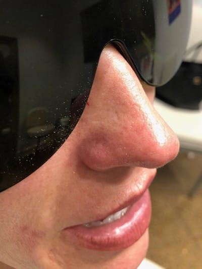 IPL Before & After Gallery - Patient 269829 - Image 2