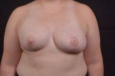 Breast Asymmetry Correction Before & After Gallery - Patient 316402 - Image 2
