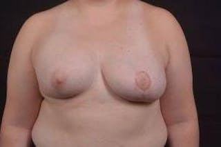 Breast Asymmetry Correction Before & After Gallery - Patient 316402 - Image 2