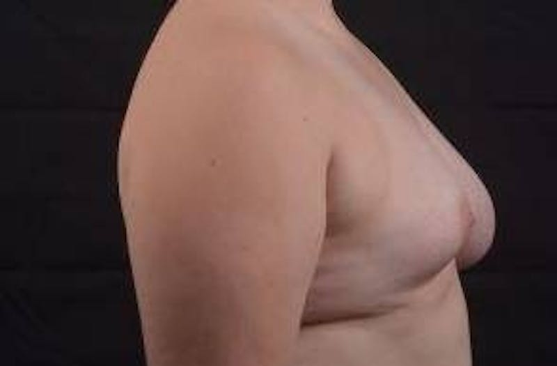 Breast Asymmetry Correction Before & After Gallery - Patient 316402 - Image 5