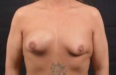 Breast Asymmetry Correction Before & After Gallery - Patient 378552 - Image 1