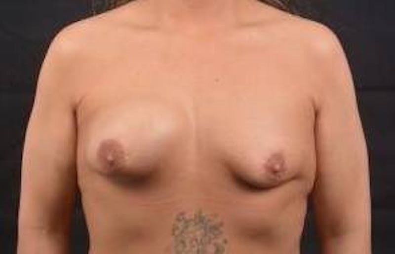 Breast Asymmetry Correction Before & After Gallery - Patient 378552 - Image 1
