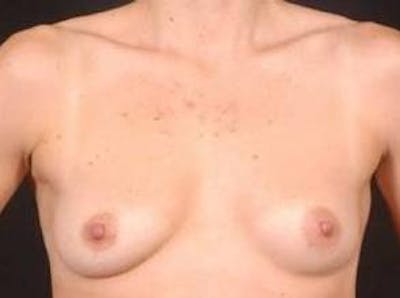 Breast Asymmetry Correction Before & After Gallery - Patient 340799 - Image 1