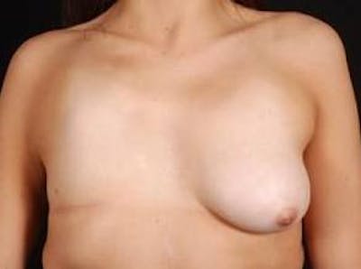 Breast Asymmetry Correction Before & After Gallery - Patient 185545 - Image 1