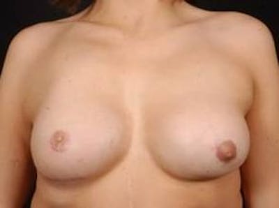 Breast Asymmetry Correction Before & After Gallery - Patient 185545 - Image 2