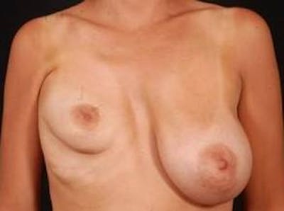 Breast Asymmetry Correction Before & After Gallery - Patient 399699 - Image 1