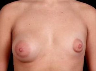 Breast Asymmetry Correction Before & After Gallery - Patient 392095 - Image 1