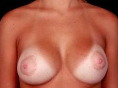 Breast Asymmetry Correction Before & After Gallery - Patient 392095 - Image 2