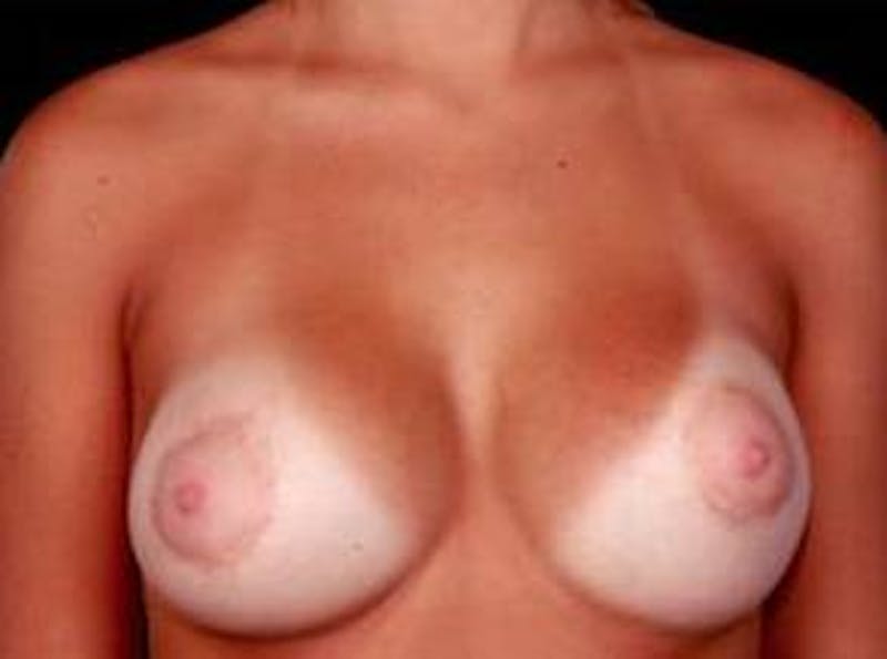Breast Asymmetry Correction Before & After Gallery - Patient 392095 - Image 2