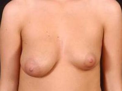 Breast Asymmetry Correction Before & After Gallery - Patient 993336 - Image 1