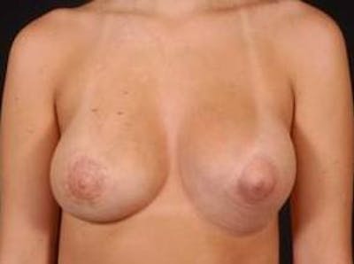 Breast Asymmetry Correction Before & After Gallery - Patient 993336 - Image 2