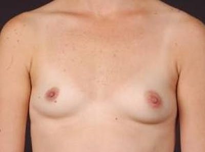 Breast Asymmetry Correction Before & After Gallery - Patient 366489 - Image 1