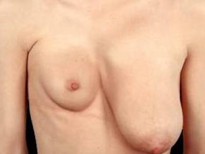 Breast Asymmetry Correction Before & After Gallery - Patient 329199 - Image 1