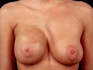 Breast Asymmetry Correction Before & After Gallery - Patient 329199 - Image 2