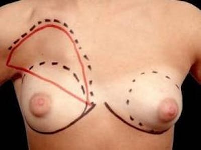 Breast Asymmetry Correction Before & After Gallery - Patient 100486 - Image 1