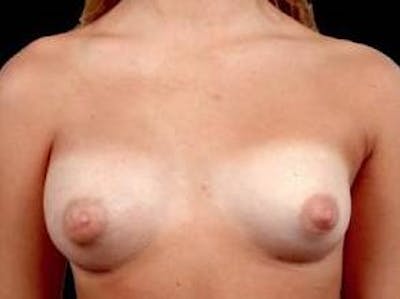 Breast Asymmetry Correction Before & After Gallery - Patient 100486 - Image 2