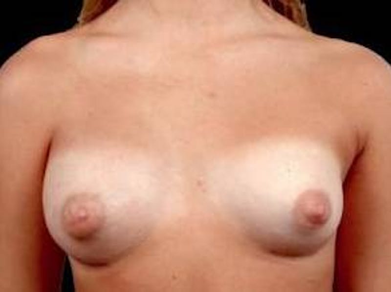 Breast Asymmetry Correction Before & After Gallery - Patient 100486 - Image 2