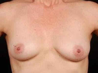 Breast Asymmetry Correction Before & After Gallery - Patient 257121 - Image 1