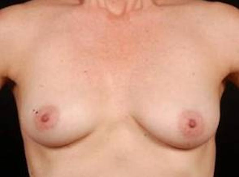 Breast Asymmetry Correction Before & After Gallery - Patient 257121 - Image 1