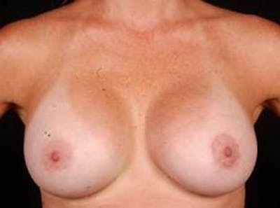 Breast Asymmetry Correction Before & After Gallery - Patient 257121 - Image 2