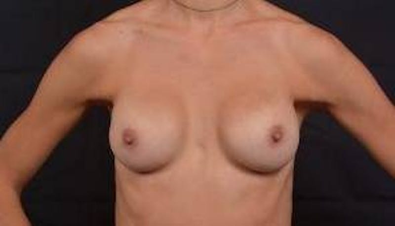 Aesthetic Breast Revision Before & After Gallery - Patient 259596 - Image 1