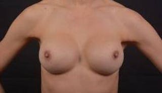 Aesthetic Breast Revision Before & After Gallery - Patient 259596 - Image 2