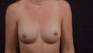 Aesthetic Breast Revision Before & After Gallery - Patient 286207 - Image 2