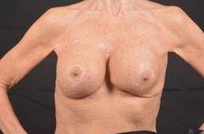 Aesthetic Breast Revision Before & After Gallery - Patient 334923 - Image 1