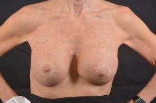 Aesthetic Breast Revision Before & After Gallery - Patient 334923 - Image 2