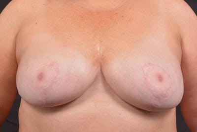 Aesthetic Breast Revision Before & After Gallery - Patient 164072 - Image 2