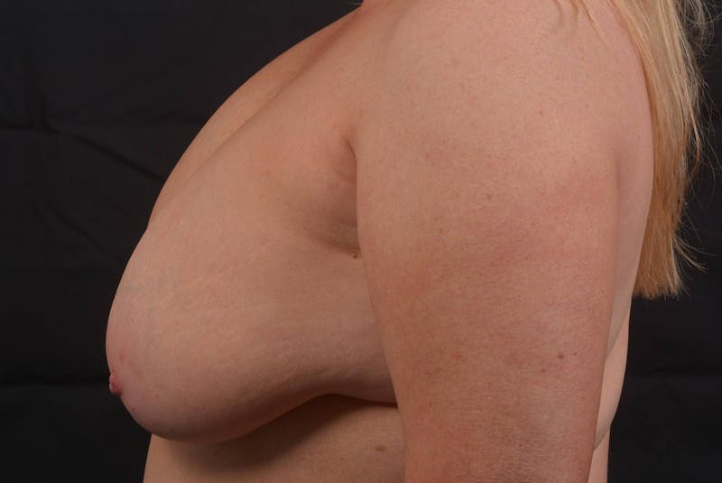 Aesthetic Breast Revision Before & After Gallery - Patient 164072 - Image 3