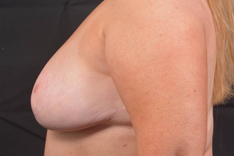 Aesthetic Breast Revision Before & After Gallery - Patient 164072 - Image 4