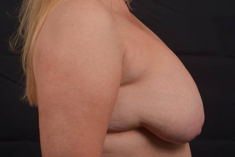 Aesthetic Breast Revision Before & After Gallery - Patient 164072 - Image 5