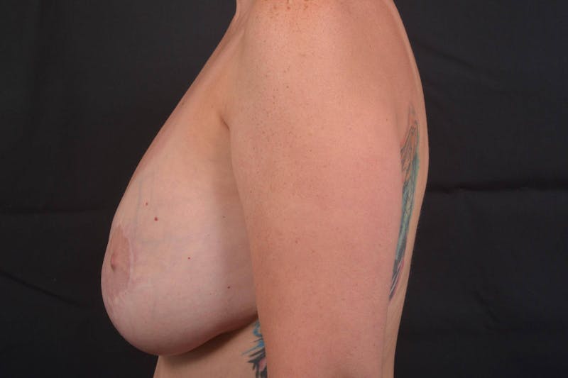 Aesthetic Breast Revision Before & After Gallery - Patient 347336 - Image 3