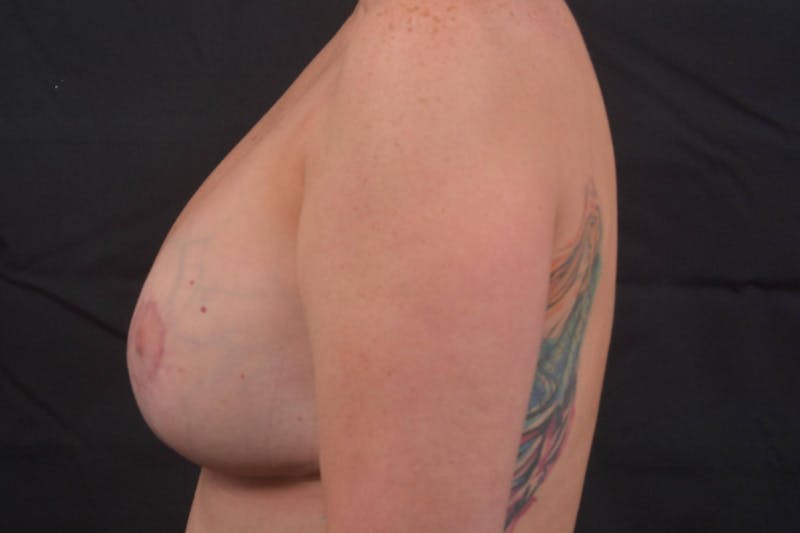 Aesthetic Breast Revision Before & After Gallery - Patient 347336 - Image 4