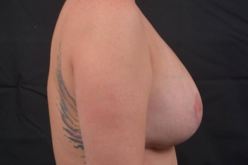Aesthetic Breast Revision Before & After Gallery - Patient 347336 - Image 6