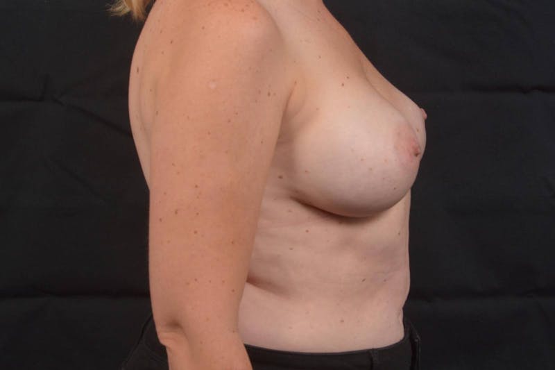 Aesthetic Breast Revision Before & After Gallery - Patient 570581 - Image 5