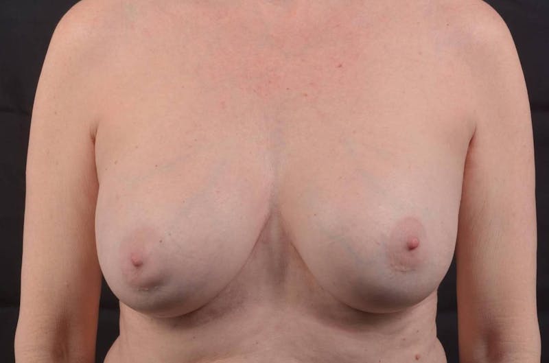 Aesthetic Breast Revision Before & After Gallery - Patient 885171 - Image 1