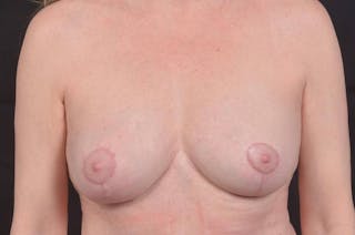 Aesthetic Breast Revision Before & After Gallery - Patient 885171 - Image 2