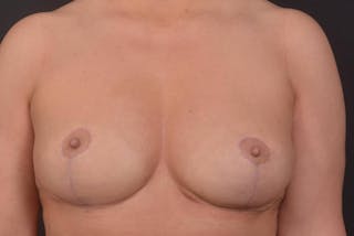 Aesthetic Breast Revision Before & After Gallery - Patient 977879 - Image 2