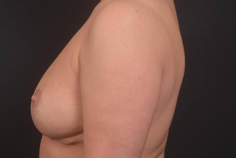 Aesthetic Breast Revision Before & After Gallery - Patient 977879 - Image 4