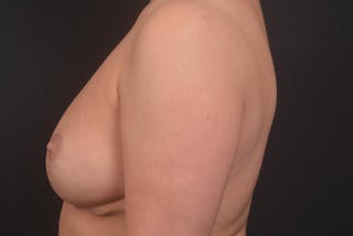 Aesthetic Breast Revision Before & After Gallery - Patient 977879 - Image 4
