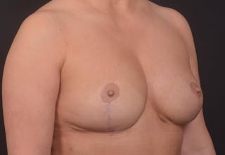 Aesthetic Breast Revision Before & After Gallery - Patient 977879 - Image 10