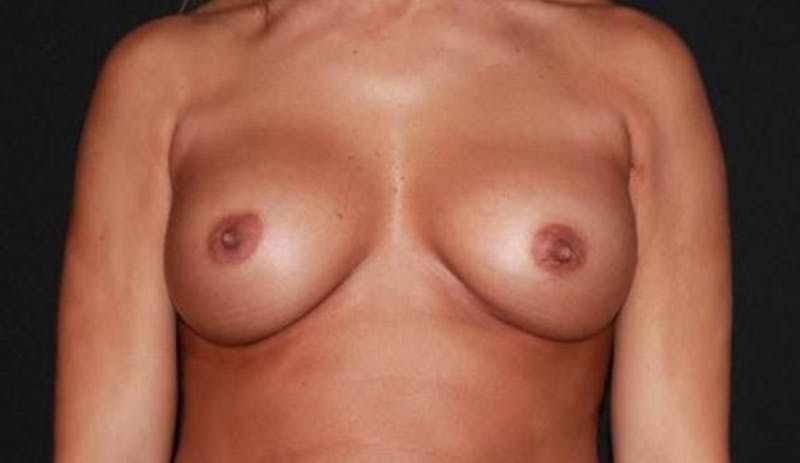 Aesthetic Breast Revision Before & After Gallery - Patient 200171 - Image 1