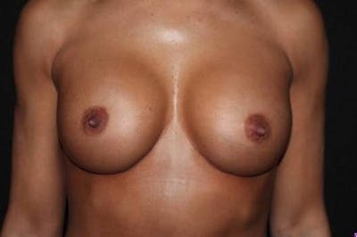 Aesthetic Breast Revision Before & After Gallery - Patient 200171 - Image 2