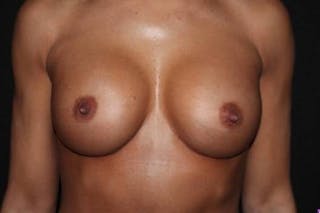 Aesthetic Breast Revision Before & After Gallery - Patient 200171 - Image 2