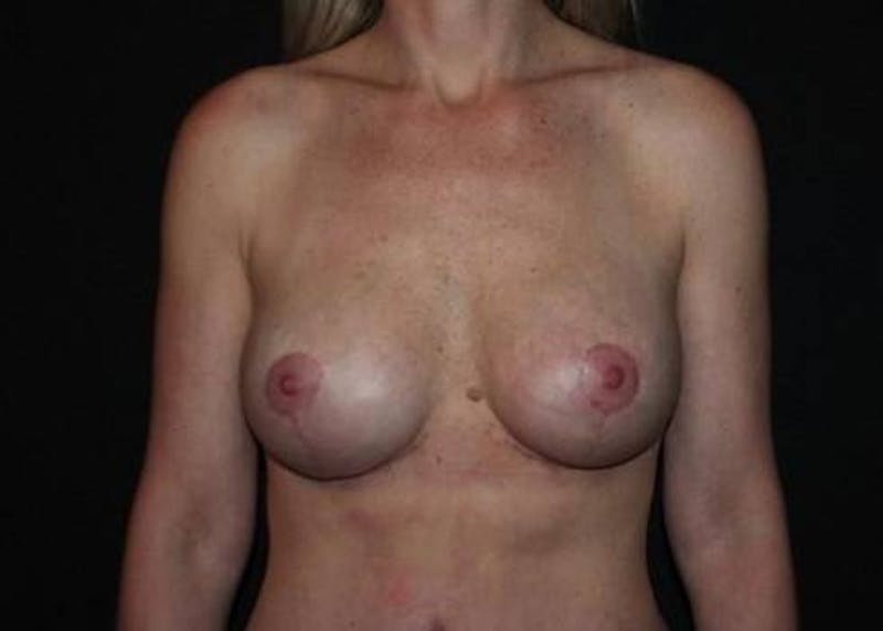 Aesthetic Breast Revision Before & After Gallery - Patient 141813 - Image 2